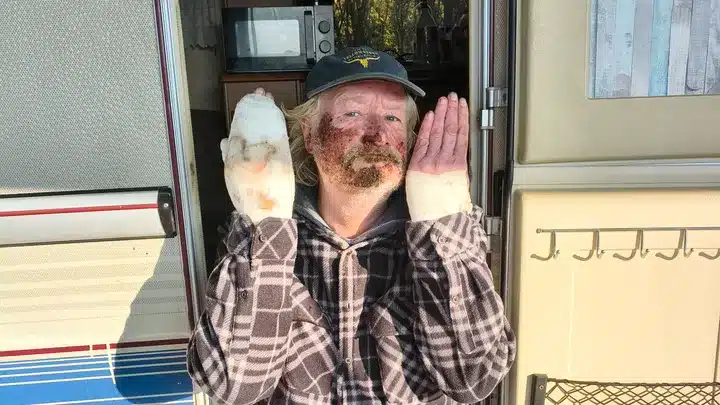 57-Jähriger erlitt schwere Verbrennungen