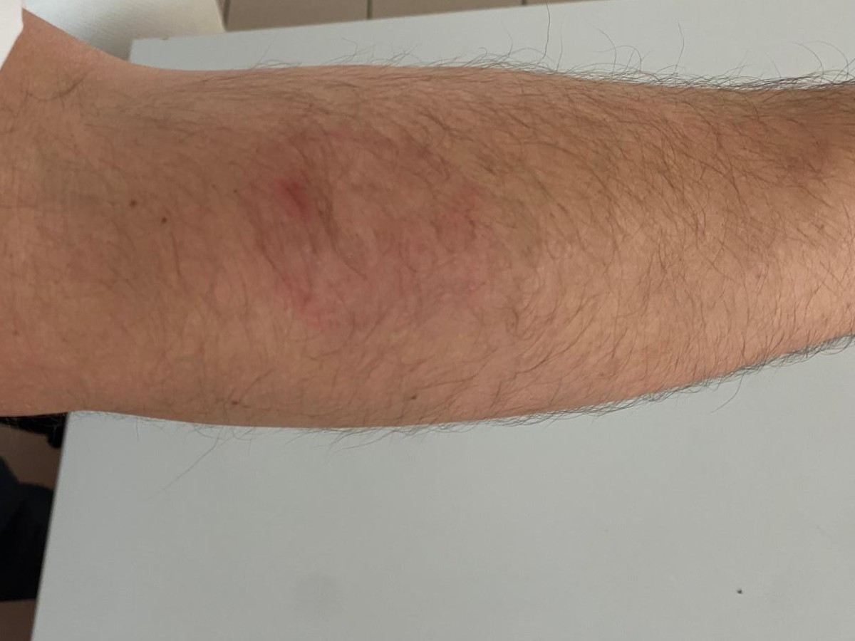 Mitarbeiter von Ladendieb gebissen