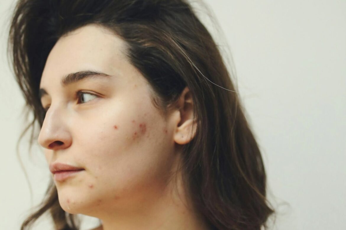 Pickel im Gesicht